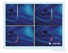 干眼病眼睛睁不开